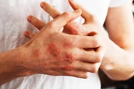 Eczema Treatment