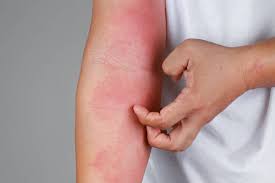 Eczema Treatment