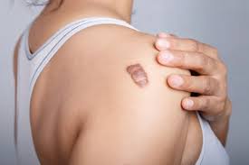 Keloid Treatment