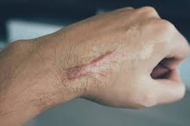 Keloid Treatment