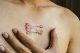 Keloid Treatment