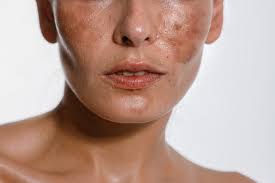 Melasma Treatment