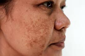 Acne Treatment