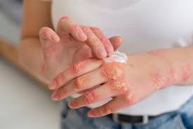 Melasma Treatment
