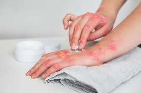 Acne Treatment