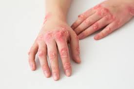 Melasma Treatment