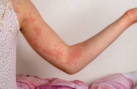 Psoriasis Treatment