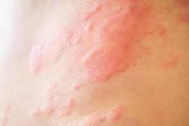 Psoriasis Treatment