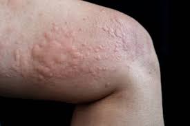 Psoriasis Treatment