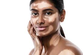 Vitiligo Treatment
