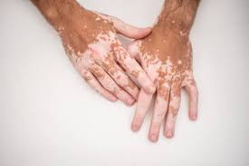 Vitiligo Treatment