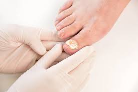 Fungal Nail Infection Treatment