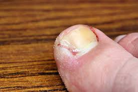 Ingrown Toenail Treatment