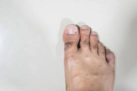 Ingrown Toenail Treatment