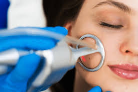 CO₂ Laser Treatment