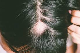 Androgenetic Alopecia Treatment