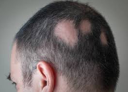 Androgenetic Alopecia Treatment
