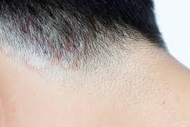 Scalp Fungal Infection Treatment
