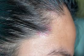Scalp Fungal Infection Treatment