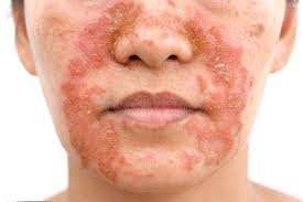 Seborrheic Dermatitis Treatment