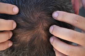 Telogen Effluvium Treatment