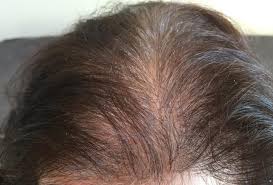 Telogen Effluvium Treatment