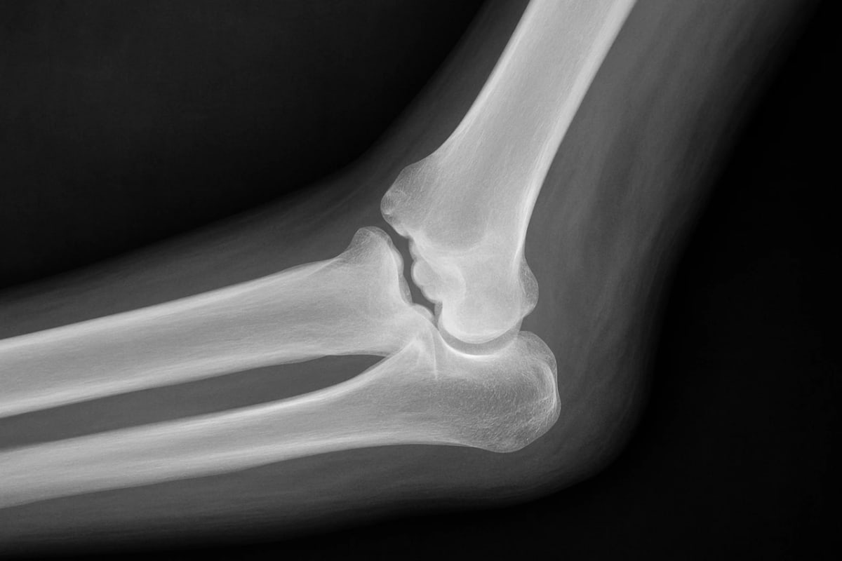 Radiografía en blanco y negro que muestra un hueso humano con fractura visible