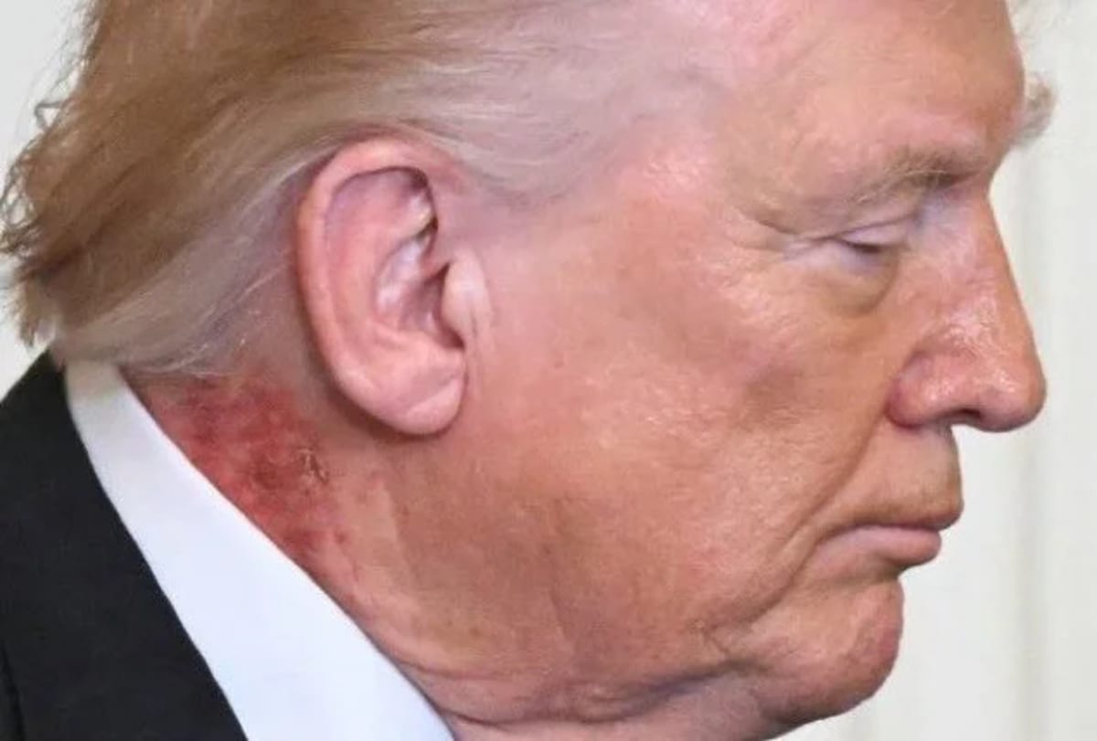 Donald Trump donde se observa una erupción rojiza en el lado derecho del cuello