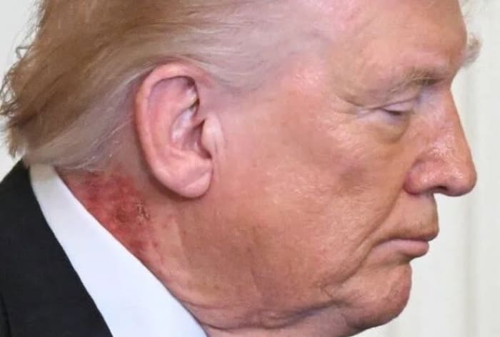 Donald Trump donde se observa una erupción rojiza en el lado derecho del cuello