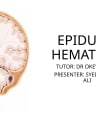 EPIDUAL HEMATOMA cover