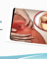 SEPTIC ARTHRITIS(J&E) cover