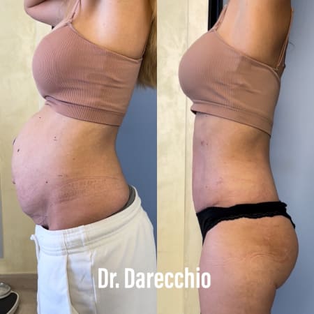 diástasis abdominal robótica dr Darecchio 