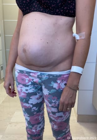 diastasis recti and hernia recurrence