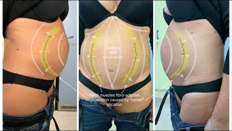 Resultados de abdominoplastia un corsé