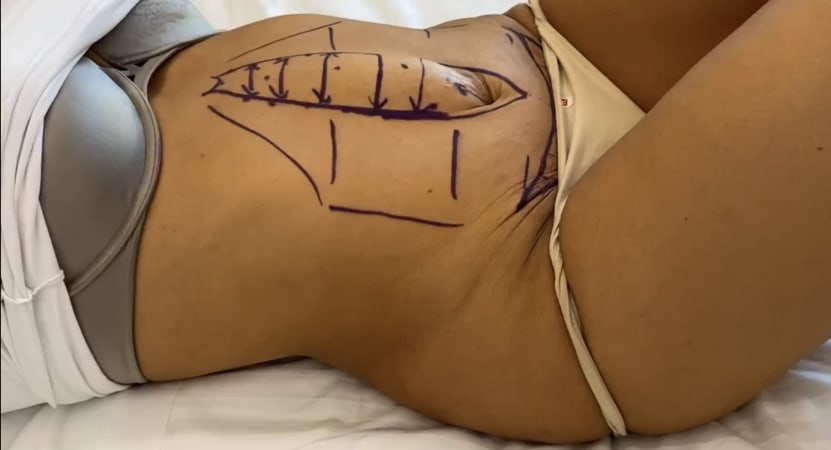 complicaciones de la recidiva de la diástasis abdominoplastia