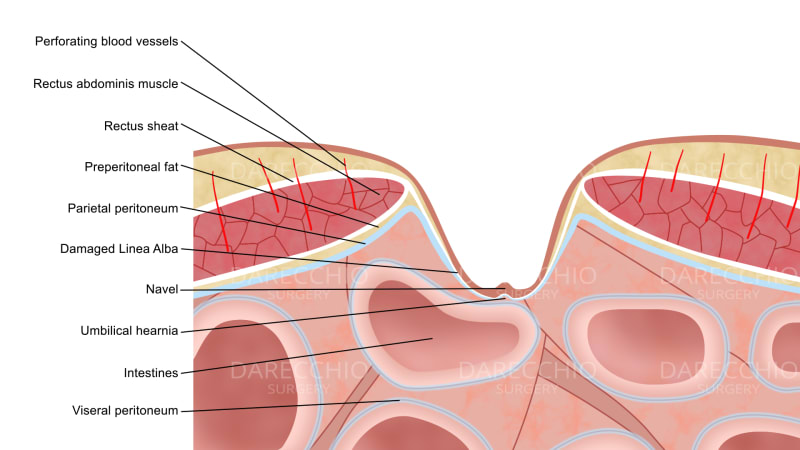 diastasis recti pathophysiology in decreasing abdominal pressure.