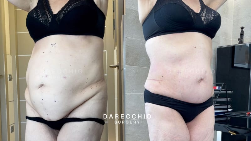 Large submebelical laparocele associated with rectus abdominis diastasis and skin-adipose laxity (3)