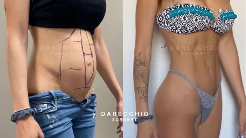 KALO Cosmetic Surgery - Rediscover Confidence👉【 #Tummy #Tuck 】for  Diastasis Recti . Are you tired of feeling self-conscious about your  postpartum belly bulge? 🤰🤱Pregnancy is a beautiful journey, but it can  leave