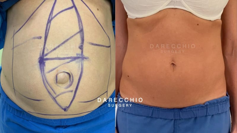 Diastasis and umbilical hernia surgery without visible scars