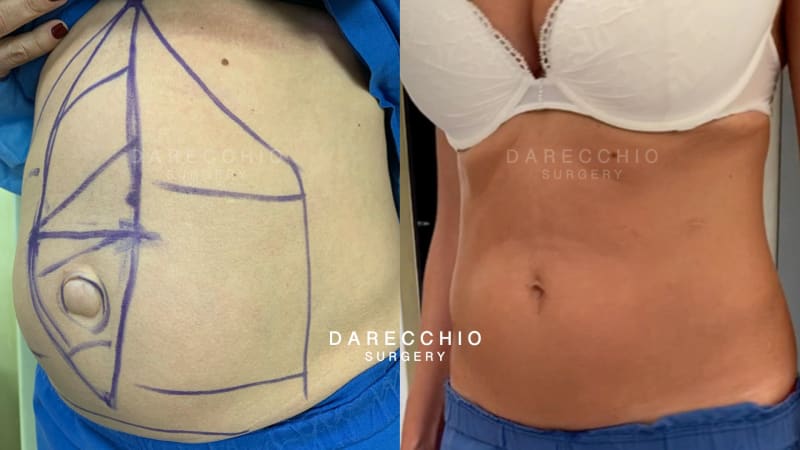 Diastasis and umbilical hernia surgery without visible scars (2)