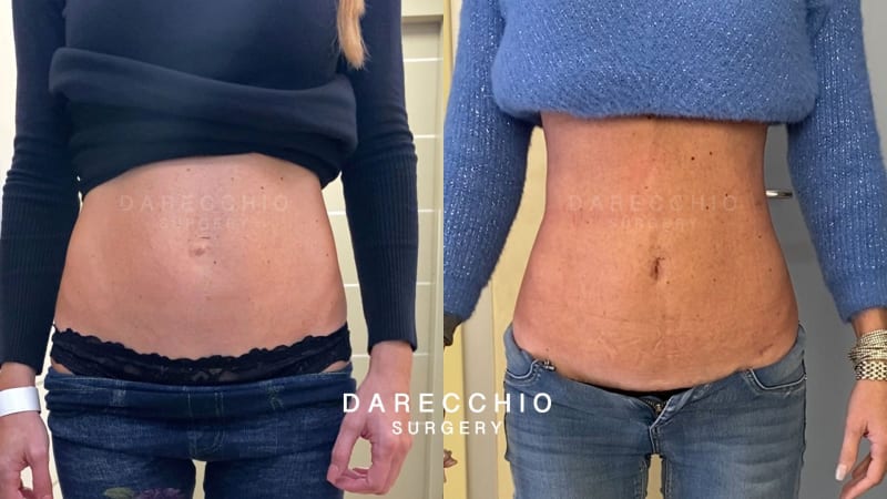 This is not abdominal fat, but a diastasis after pregnancy