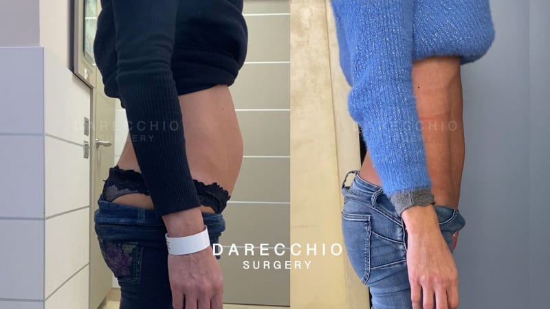 No se trata de grasa abdominal, sino de diástasis después del embarazo 2