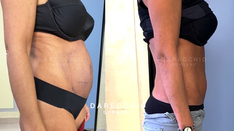 diástasis de rectos abdominales, adiposidad subcutánea localizada 2