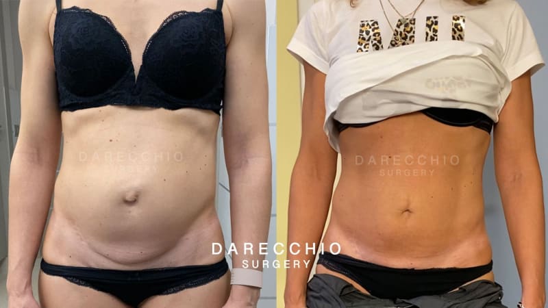 Abdomen deformado por un gran diástasis de rectos abdominales