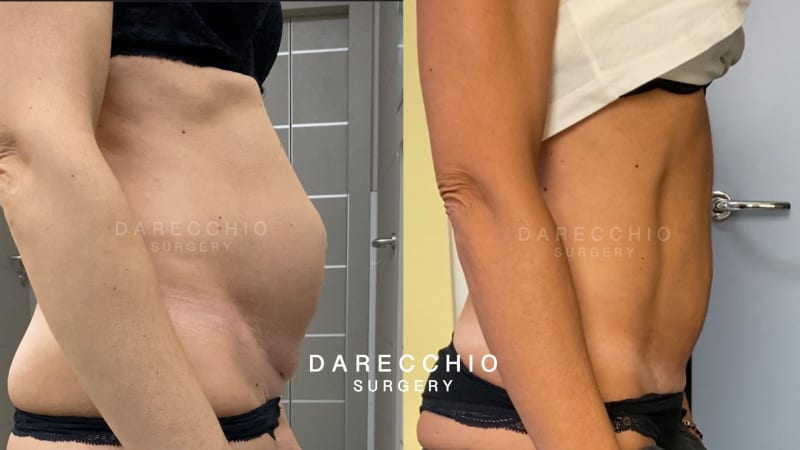 Abdomen deformed by a large rectus abdominis diastasis 2