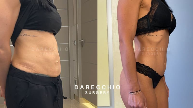 Diastasis surgery