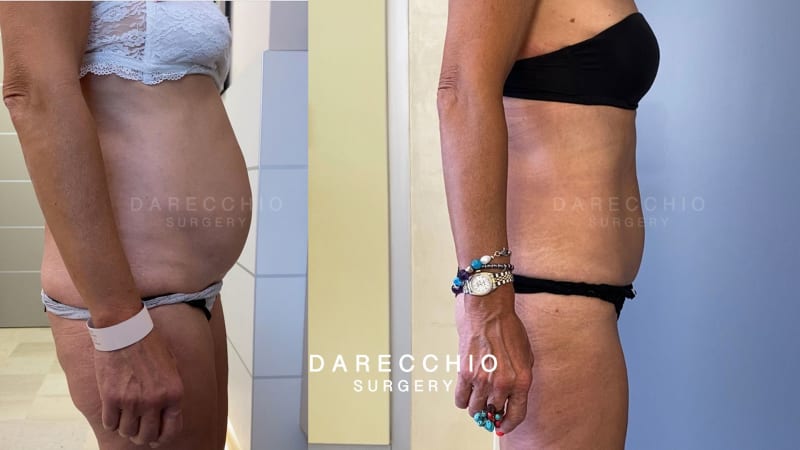 Hernia espigada rara, adherencias en cesárea y diástasis de rectos abdominales 2