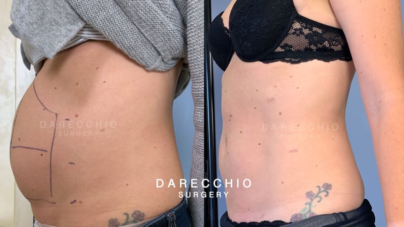 Hernies ombilicales et médianes | Darecchio Surgery