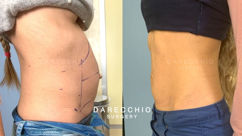 Extremely thin patient with large rectus abdominis diastasis and umbilical hernia