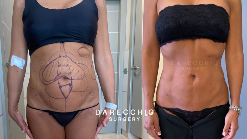 Hochauflösende Liposkulptur und robotergestützte Rekonstruktion bei Diastasen. Dr. A. Darecchio